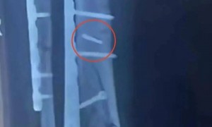 两人同病房同一天手术，体内都遗落手术钻头，医院和患者达成和解，相关医师此前已被行政处罚